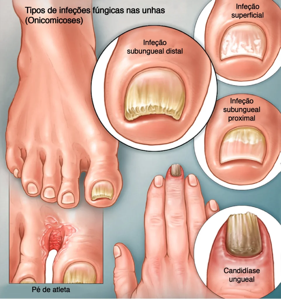 micose nas unhas (2)