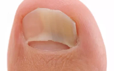 Micose nas unhas: o que fazer?